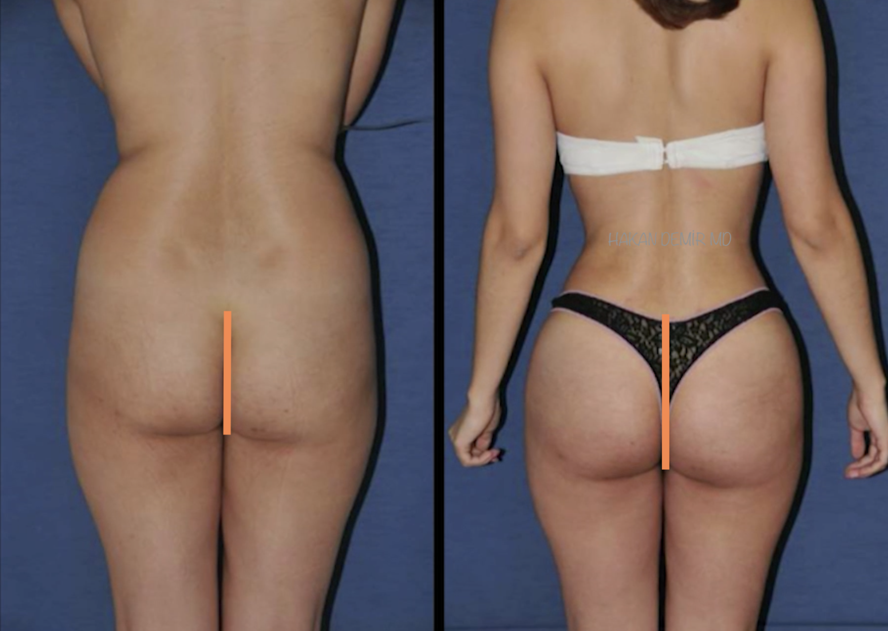 buttock-lipofilling