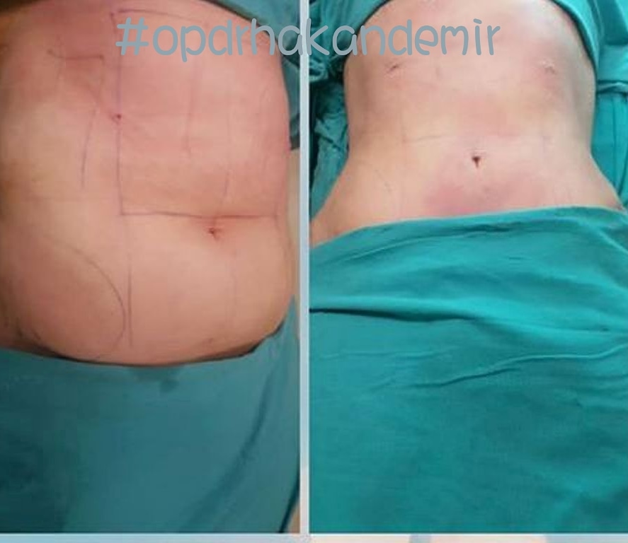 lipomatic-tummytuck