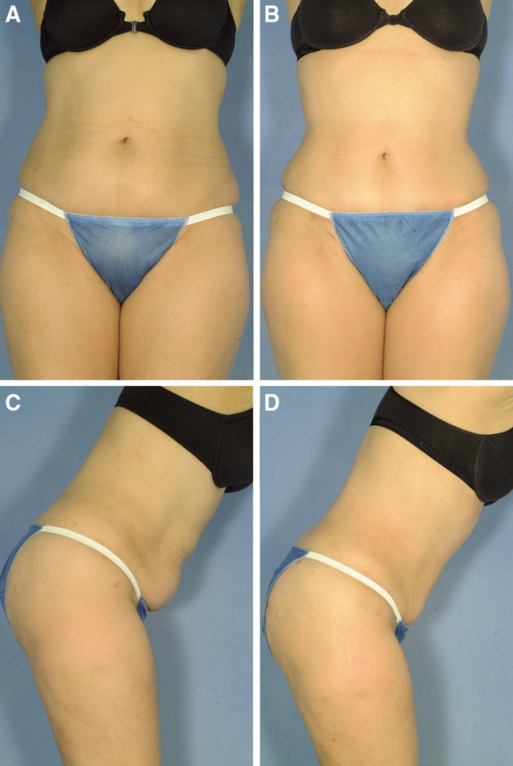 liposuction