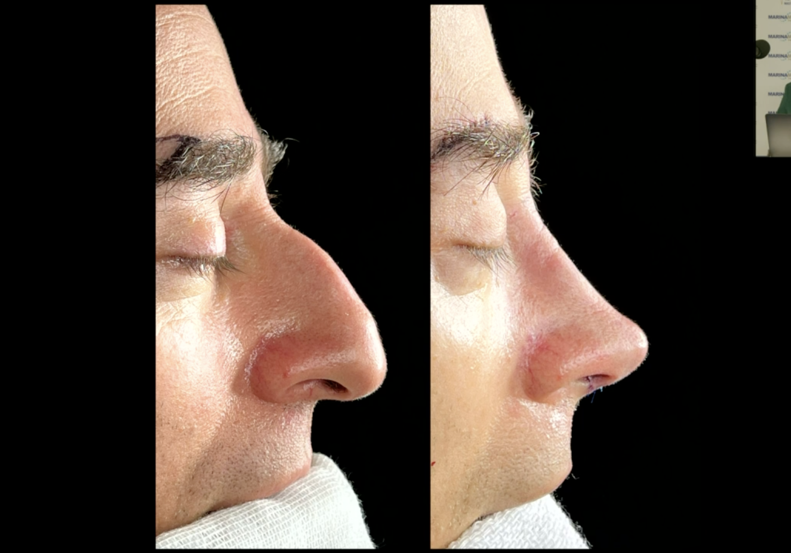 men-nose-surgery