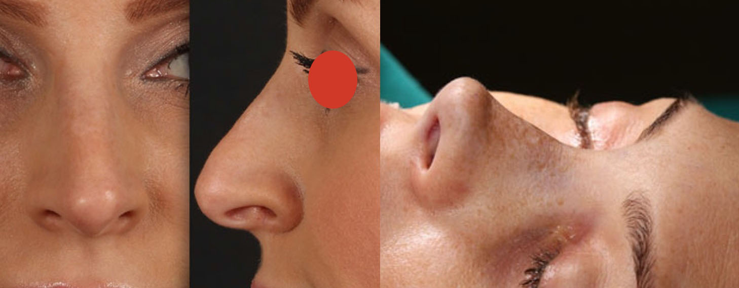 nose-rhinoplasty